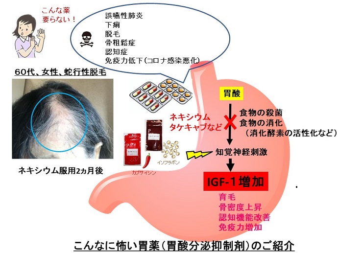 円形脱毛症　病院